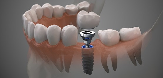 Illustration of a single dental implant in a translucent lower arch with faded gray background