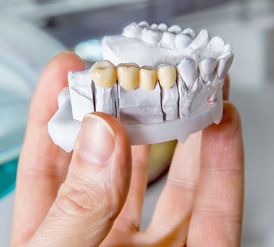 A close-up of a dental bridge against a blue background