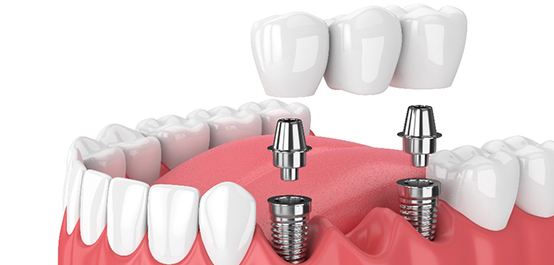 A 3D illustration of a dental bridge