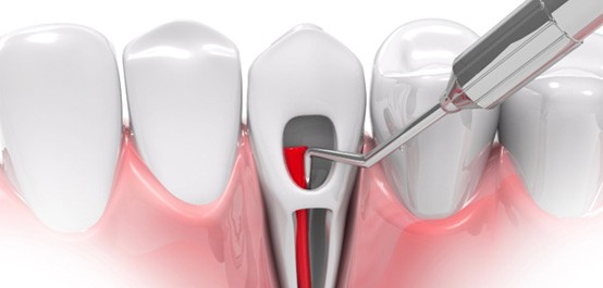 3D render of a root canal