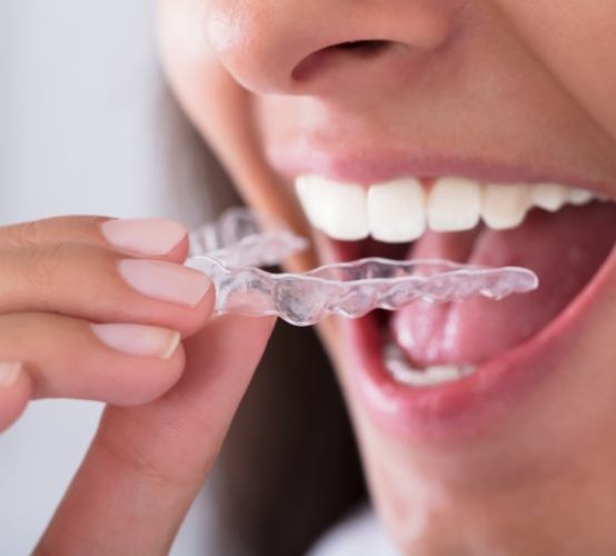 Patient placing clear Invisalign tray