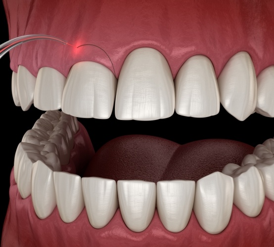 Animated smile during gum recontouring treatment