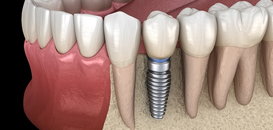Animated smile with dental implant supported dental crown in place