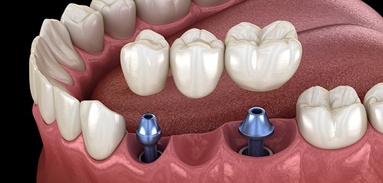 Animated smile during dental implant supported fixed bridge placement