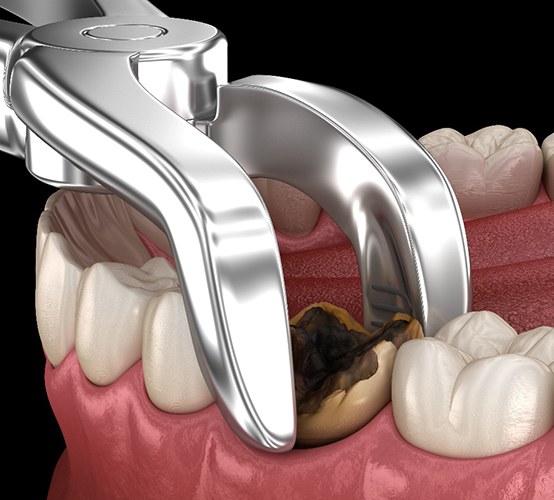 Example of a tooth extraction at Infinite Smiles Dentistry