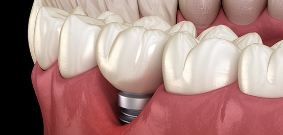 A dental implant in Owasso