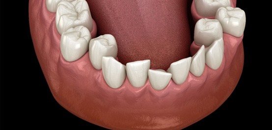 Illustration of crowded teeth