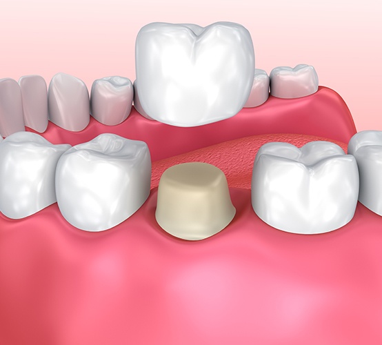 Animated dental crown placement