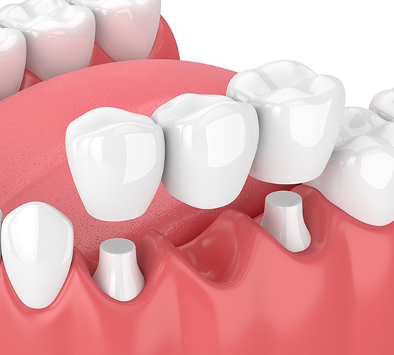 Animated dental bridge placement