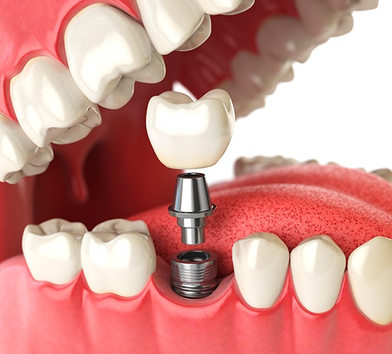 Animated dental implant supported dental crown placement