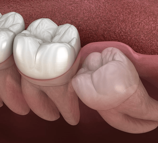 a digital illustration of an impacted wisdom tooth
