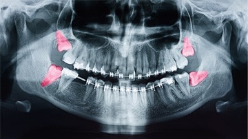 x-ray of impacted wisdom teeth