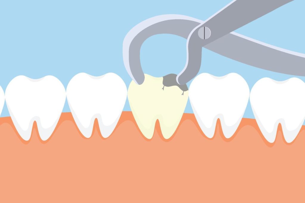 illustration of tooth being extracted