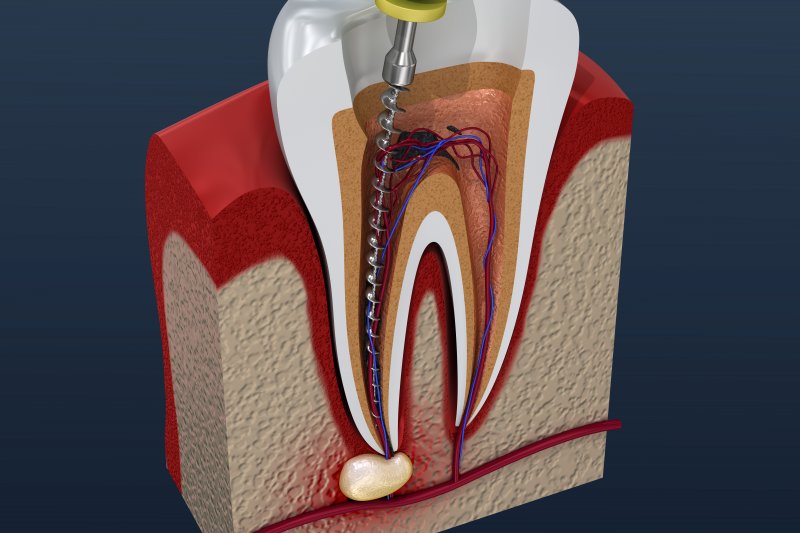 diagram of a root canal
