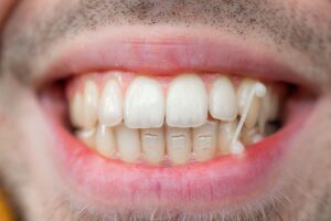 Closeup of Invisalign attachments on man's teeth