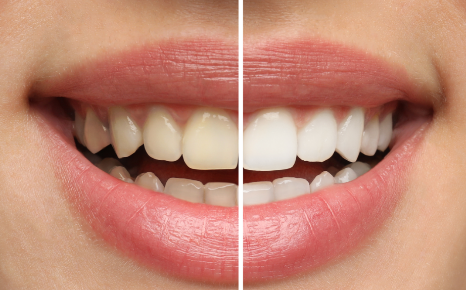 Woman smiling with half white teeth, half discolored teeth