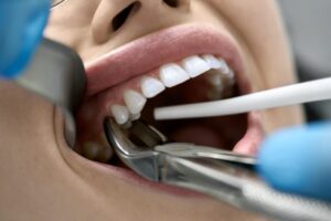 Tooth extraction.