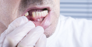 Man pulling down lip to show missing tooth